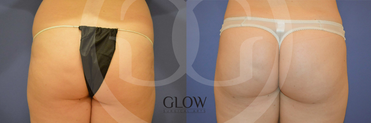 Glow Surgical Arts Body Fat Transfer