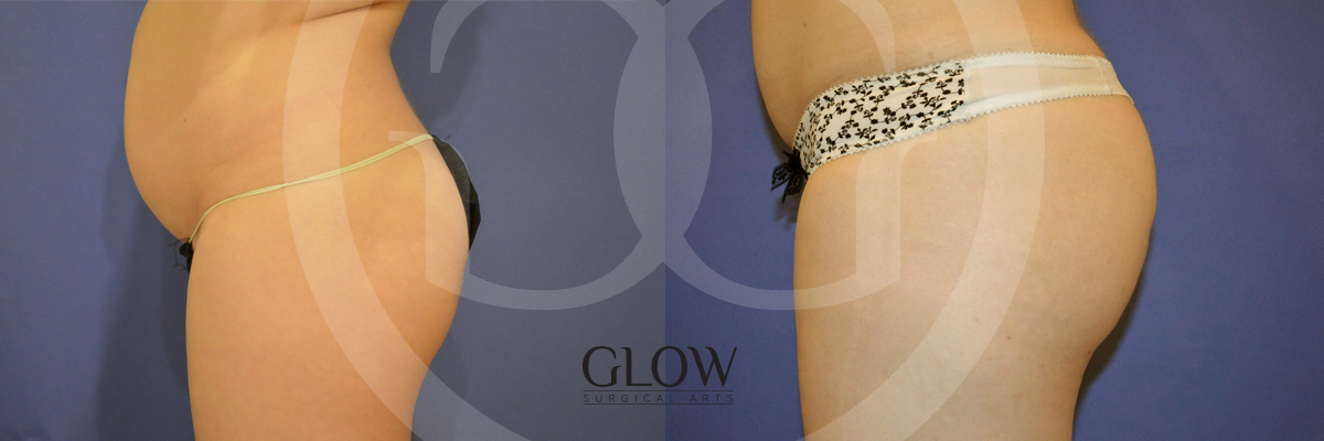 Glow Surgical Arts Body Fat Transfer