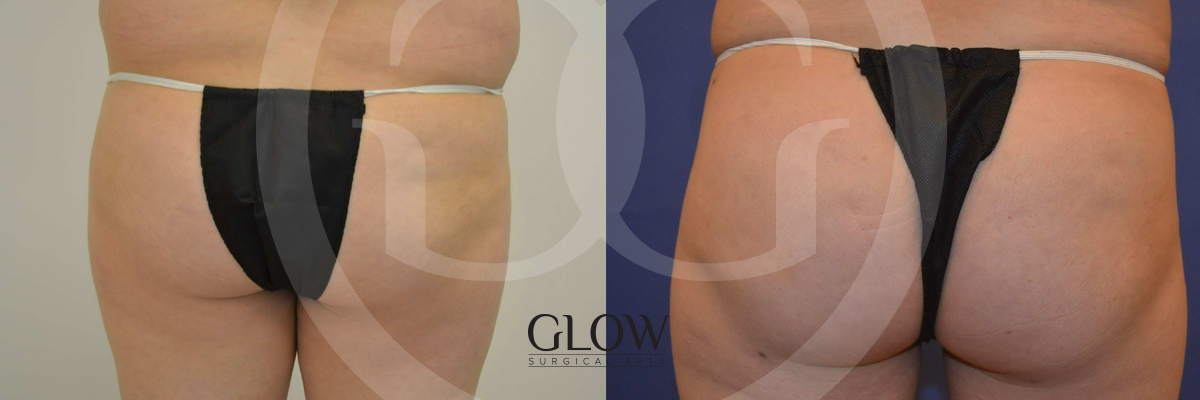 Glow Surgical Arts Body Fat Transfer