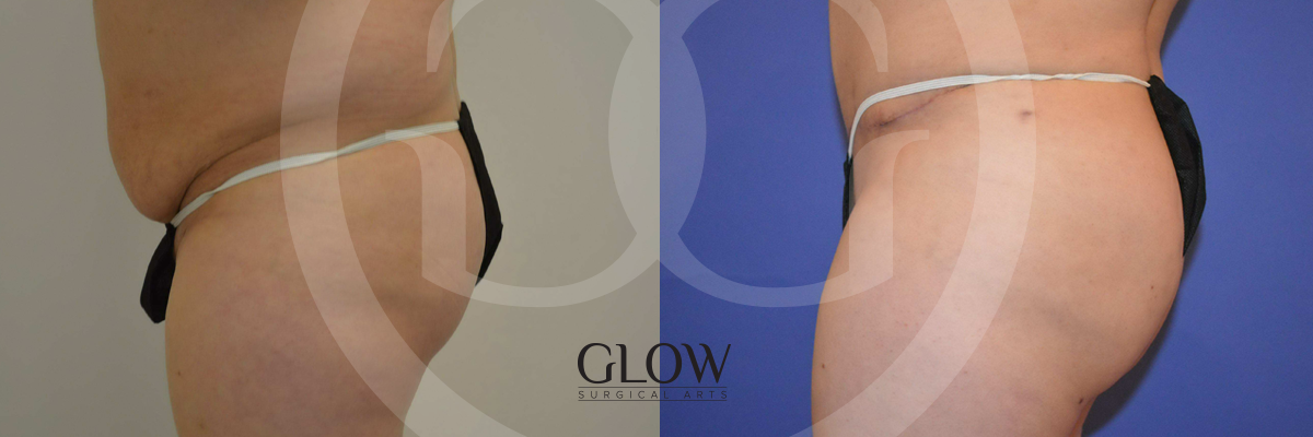 Glow Surgical Arts Body Fat Transfer