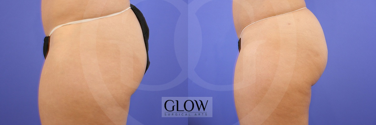 Glow Surgical Arts Body Fat Transfer