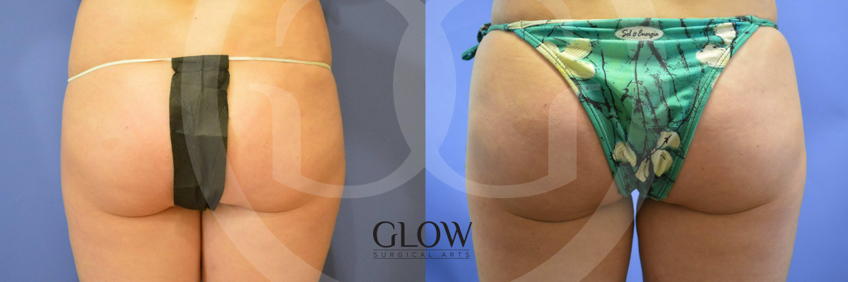 Glow Surgical Arts Body Fat Transfer