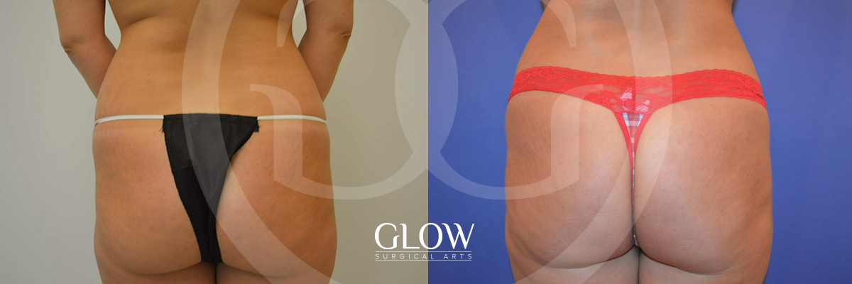 Glow Surgical Arts Body Fat Transfer