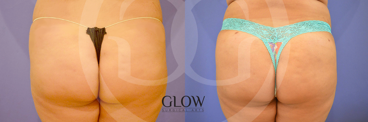 Glow Surgical Arts Body Fat Transfer