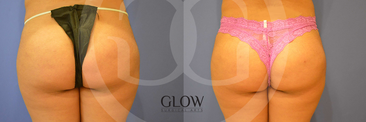 Glow Surgical Arts Body Fat Transfer