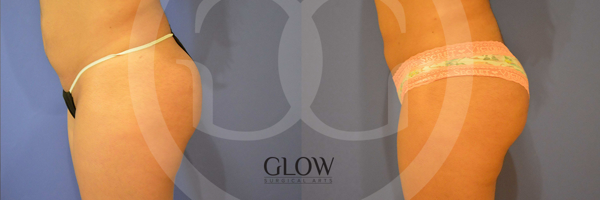 Glow Surgical Arts Body Fat Transfer