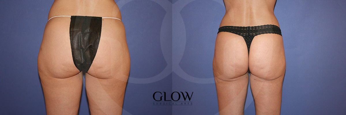 Glow Surgical Arts Body Fat Transfer