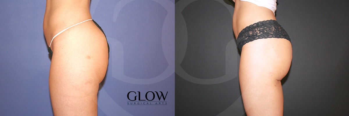 Glow Surgical Arts Body Fat Transfer