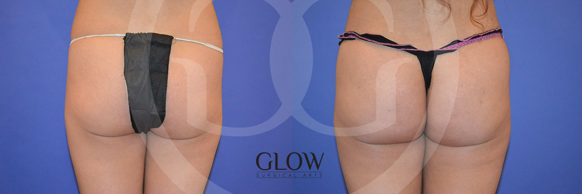 Glow Surgical Arts Body Fat Transfer