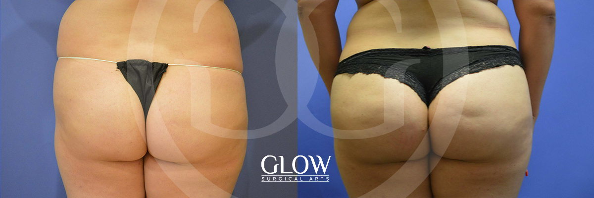 Glow Surgical Arts Body Fat Transfer