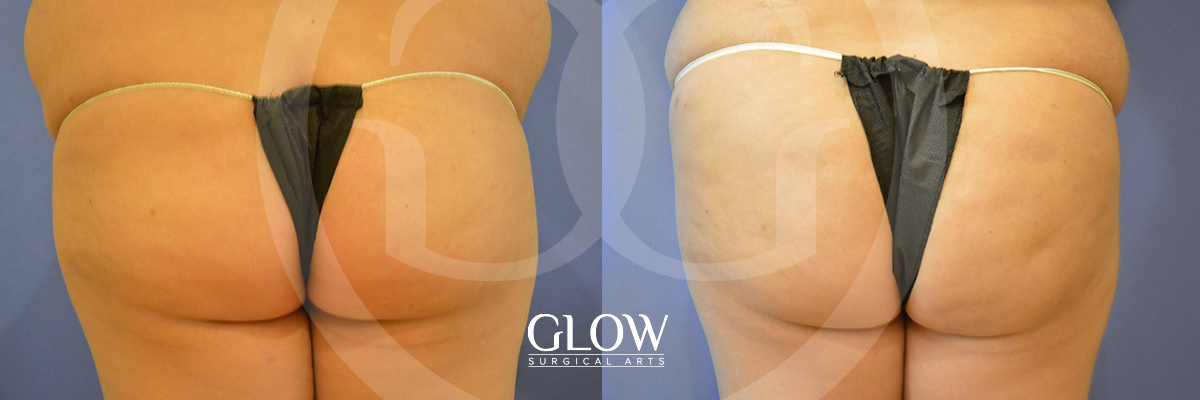 Glow Surgical Arts Body Fat Transfer