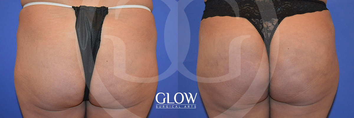 Glow Surgical Arts Body Fat Transfer