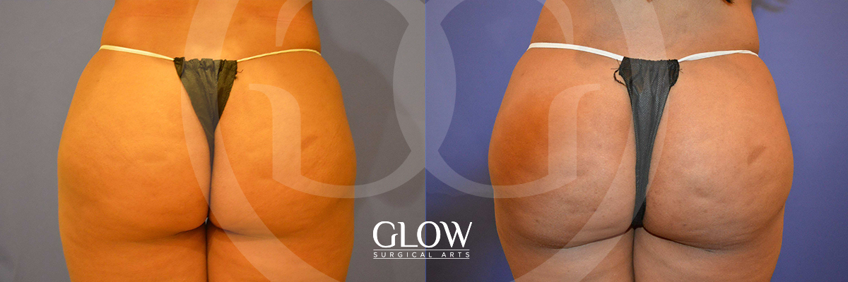 Glow Surgical Arts Body Fat Transfer