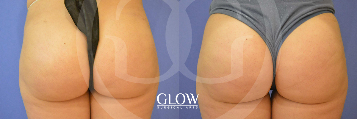 Glow Surgical Arts Body Fat Transfer