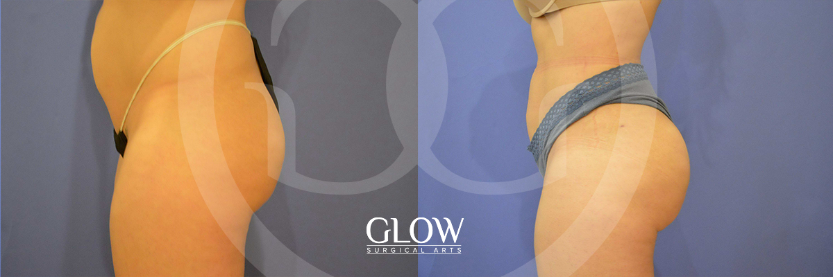 Glow Surgical Arts Body Fat Transfer