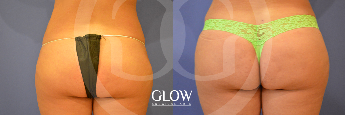 Glow Surgical Arts Body Fat Transfer