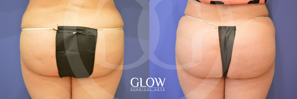 Glow Surgical Arts Body Fat Transfer