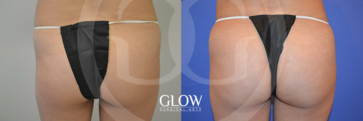 Glow Surgical Arts Body Fat Transfer