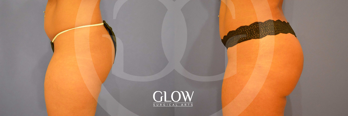 Glow Surgical Arts Body Fat Transfer