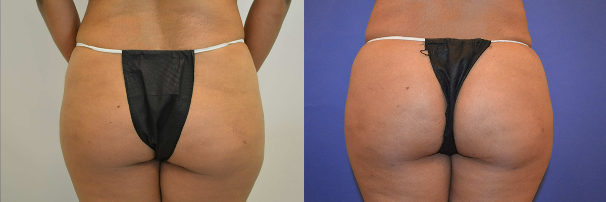Glow Surgical Arts Body Fat Transfer