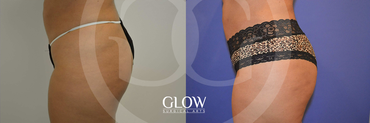 Glow Surgical Arts Body Fat Transfer