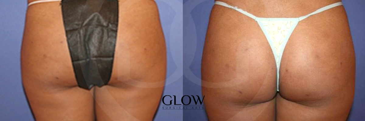 Glow Surgical Arts Body Fat Transfer