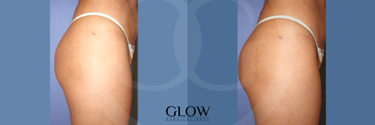 Glow Surgical Arts Body Fat Transfer