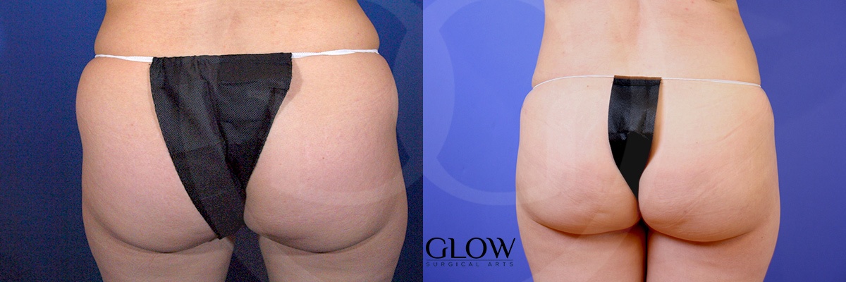 Glow Surgical Arts Body Fat Transfer