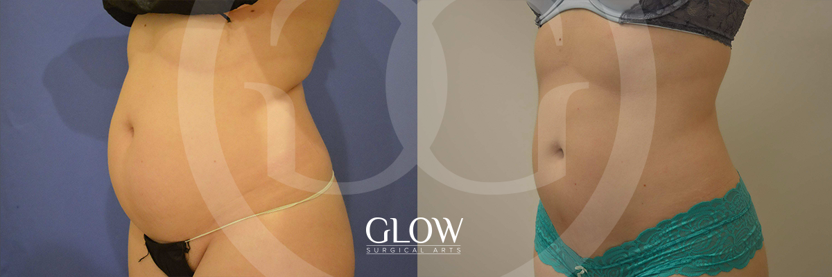 Liposuction from Glow Surgical Arts