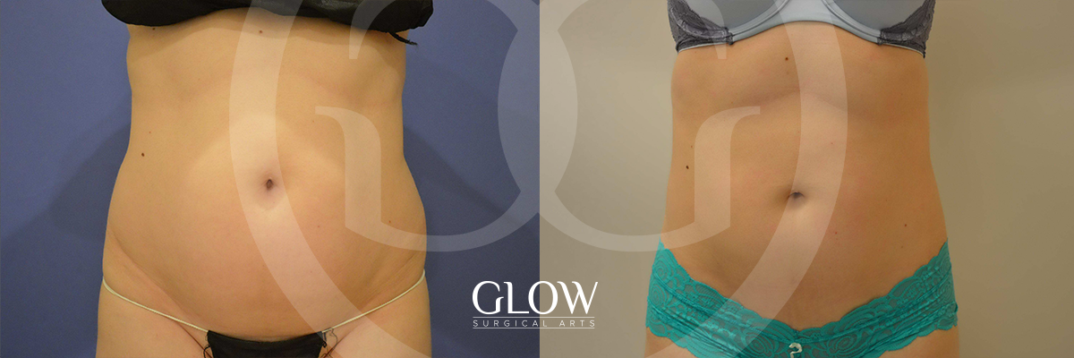 Liposuction from Glow Surgical Arts