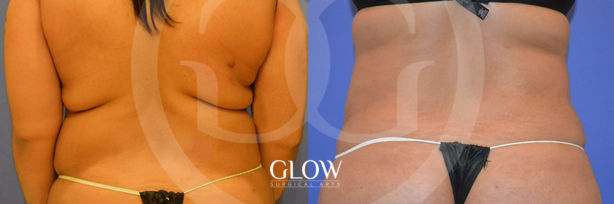 Liposuction from Glow Surgical Arts