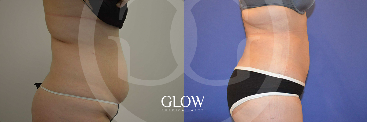 Liposuction from Glow Surgical Arts
