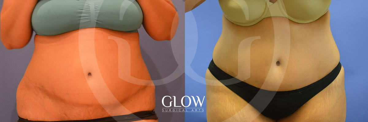 Liposuction from Glow Surgical Arts