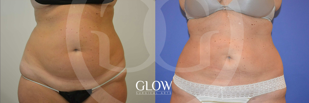 Liposuction from Glow Surgical Arts