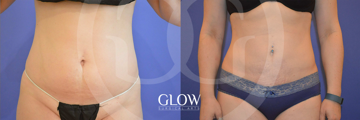 Liposuction from Glow Surgical Arts