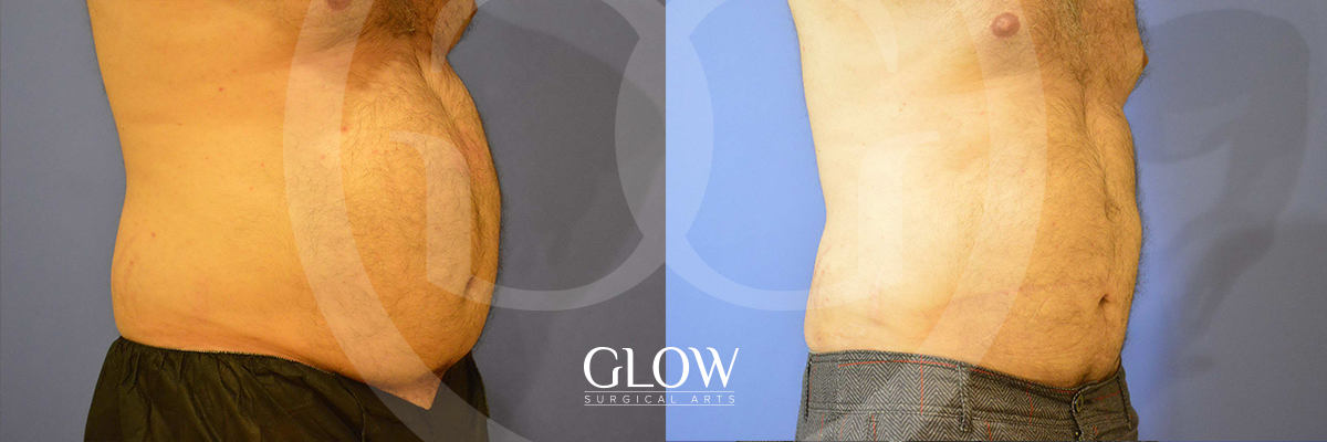 Liposuction from Glow Surgical Arts