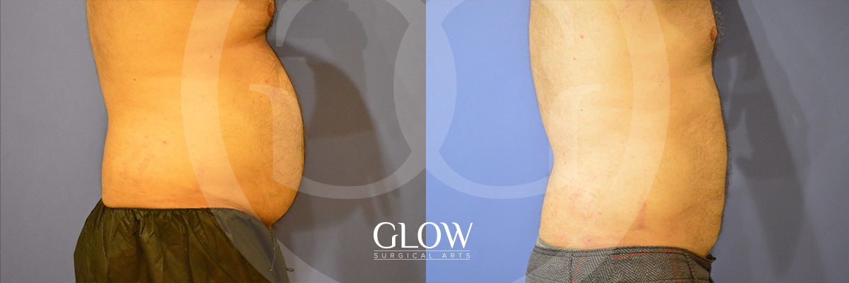 Liposuction for men from Glow Surgical Arts