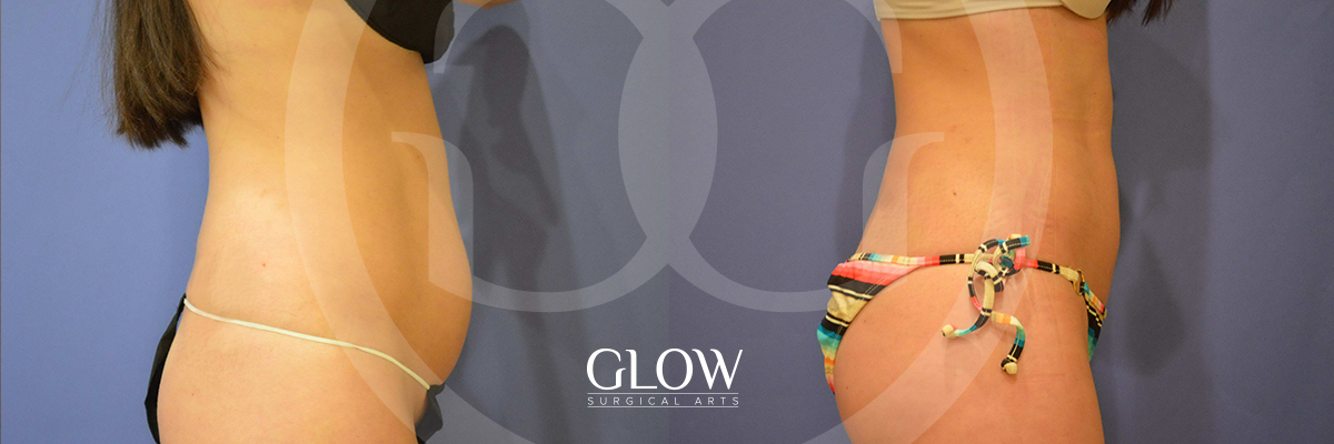 Liposuction from Glow Surgical Arts