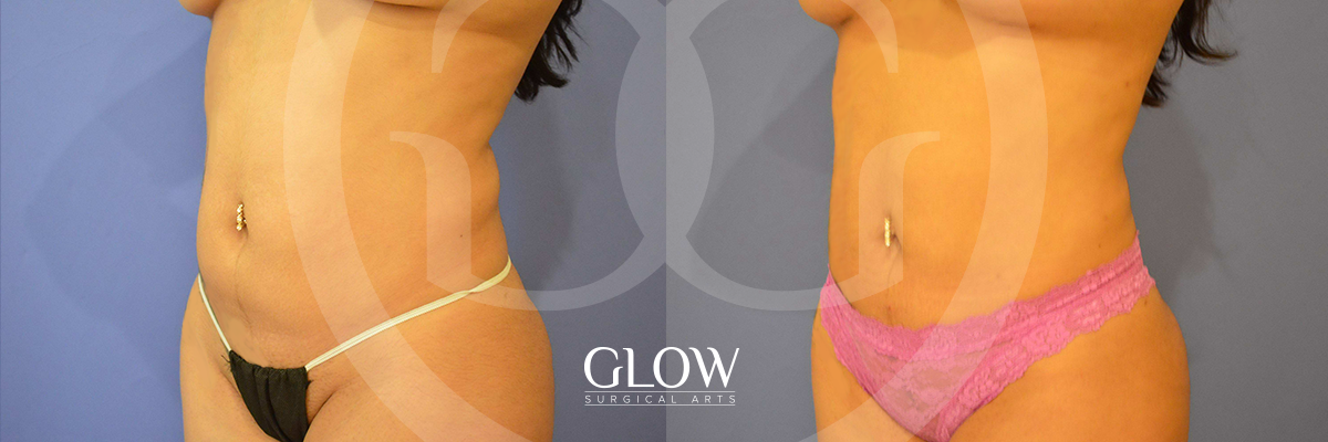 Liposuction from Glow Surgical Arts