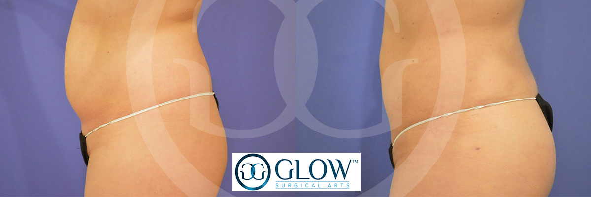 Liposuction from Glow Surgical Arts