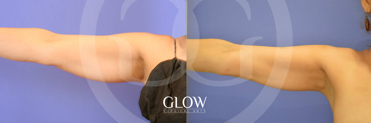 Liposuction from Glow Surgical Arts