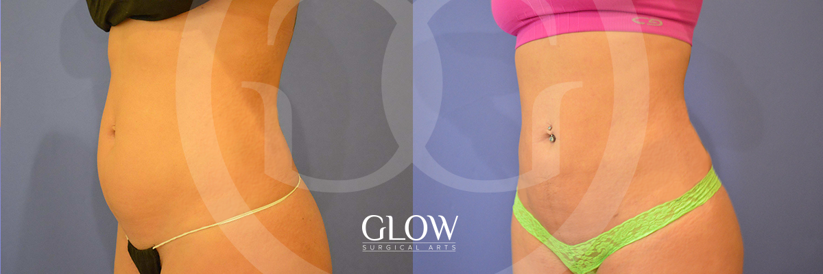 Liposuction from Glow Surgical Arts