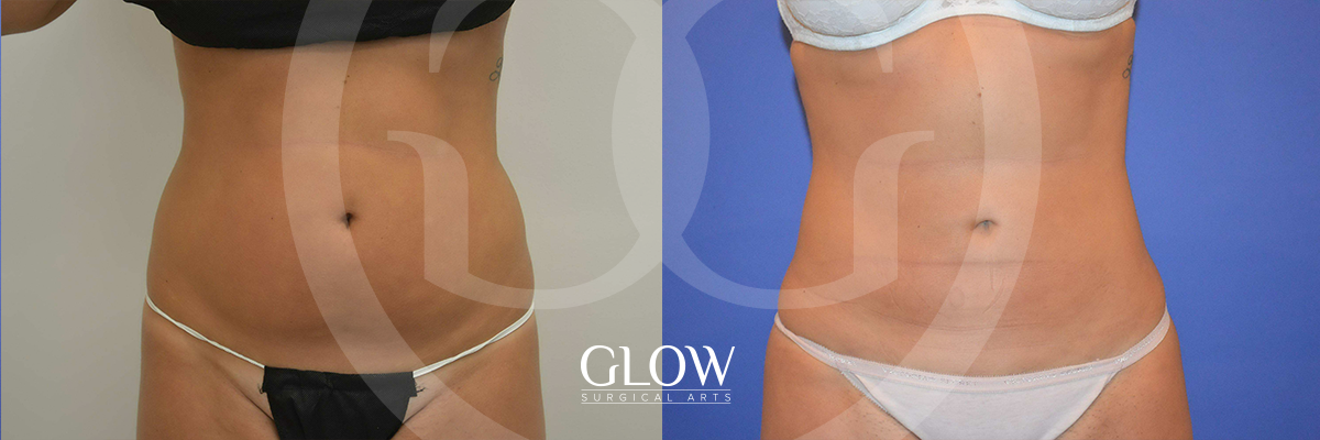 Liposuction from Glow Surgical Arts