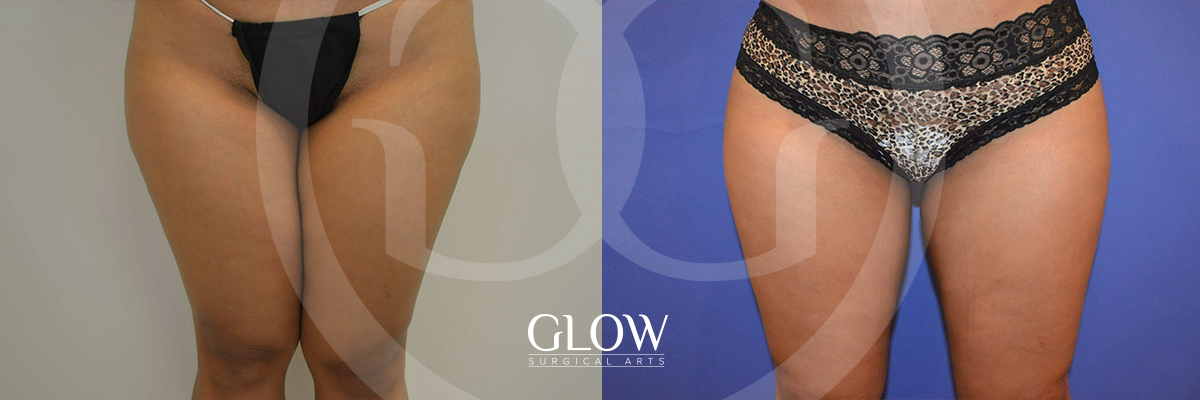 Liposuction from Glow Surgical Arts