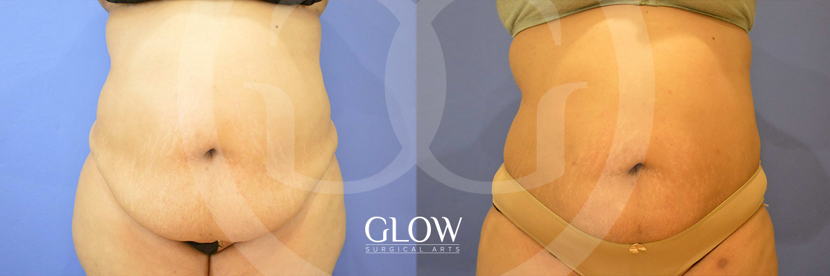 Liposuction from Glow Surgical Arts