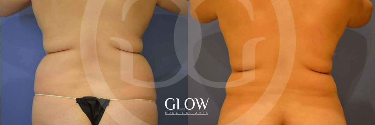 Liposuction from Glow Surgical Arts