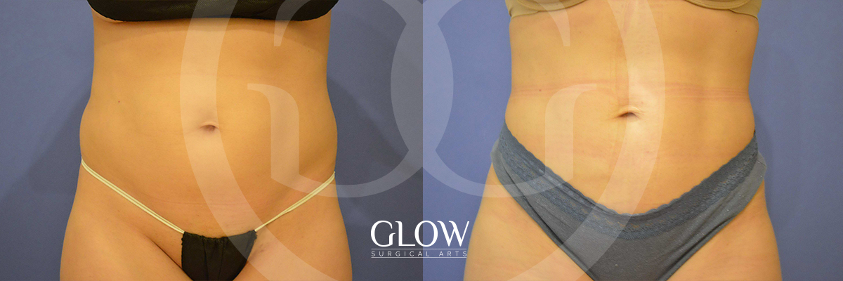 Liposuction from Glow Surgical Arts