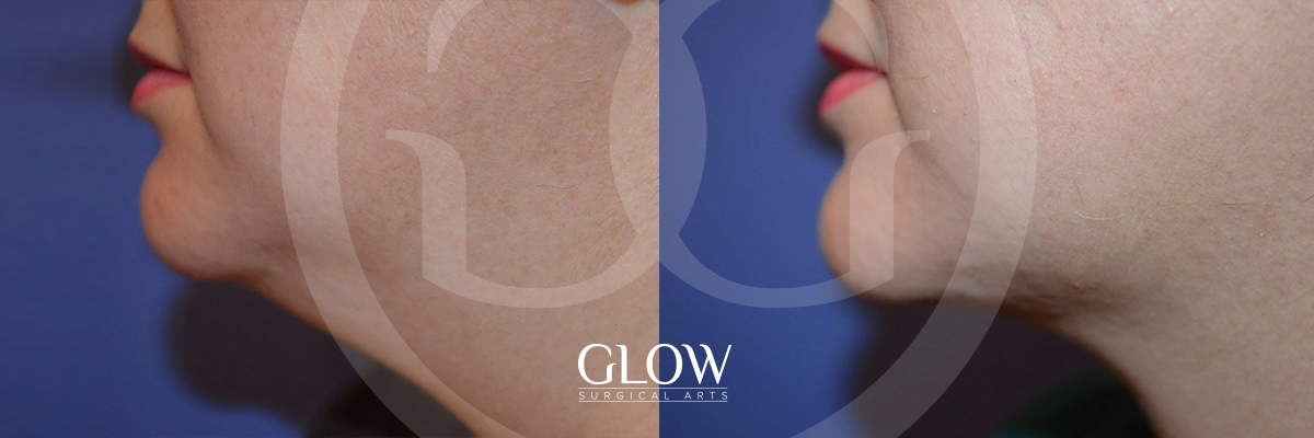 Liposuction from Glow Surgical Arts