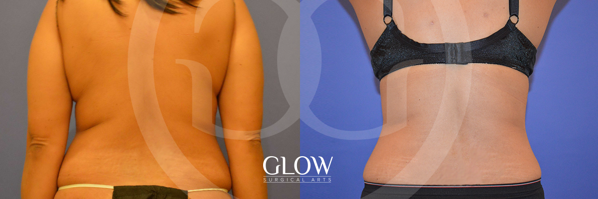 Liposuction from Glow Surgical Arts