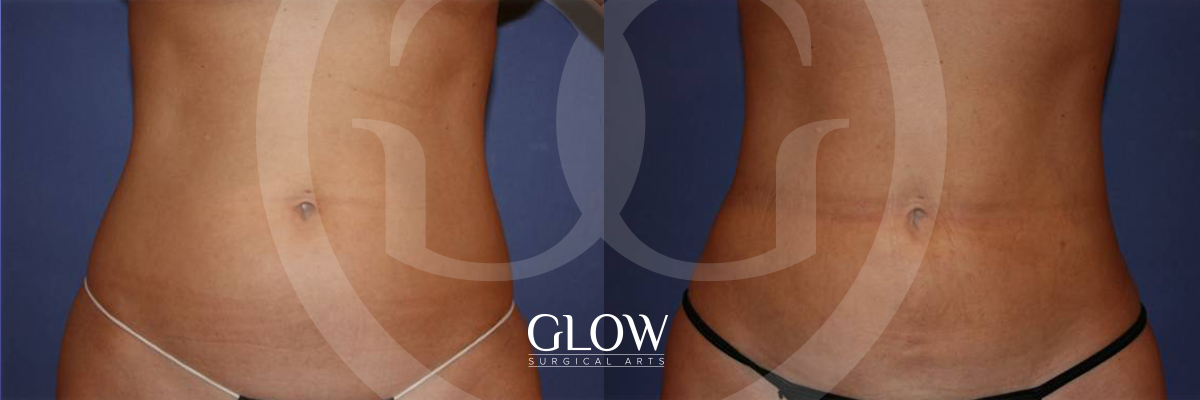 Liposuction from Glow Surgical Arts